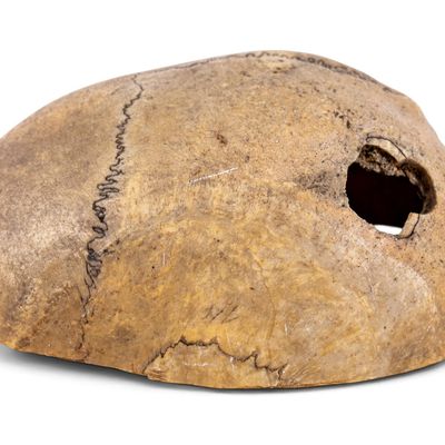 19th C Medical Cranium Specimen
