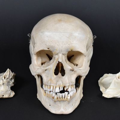 Anatomical Teaching Specimen of a Human Skull with Temporal Dissections